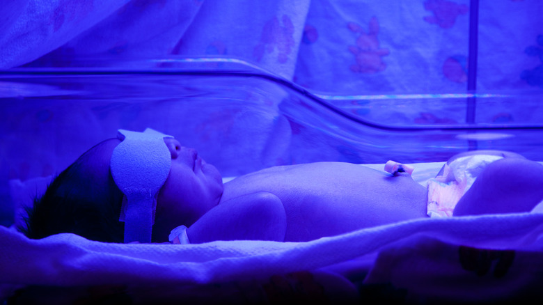 baby with neonatal jaundice receiving treatment