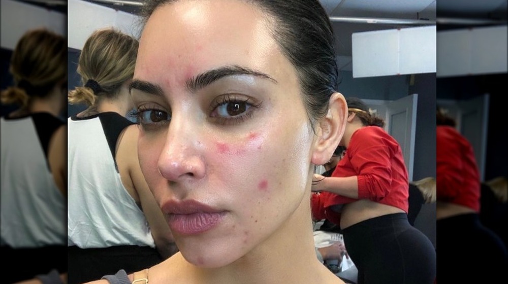 Kim Kardashian showing her psoriasis flare-up on her face