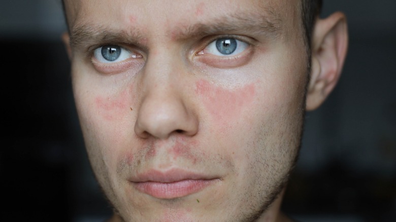 man with butterfly rash on face