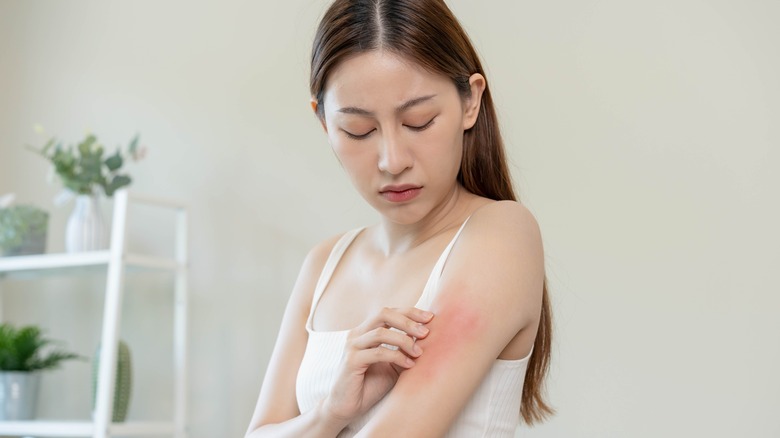 woman with eczema flare-up