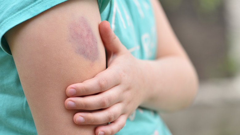 a large bruise on an arm