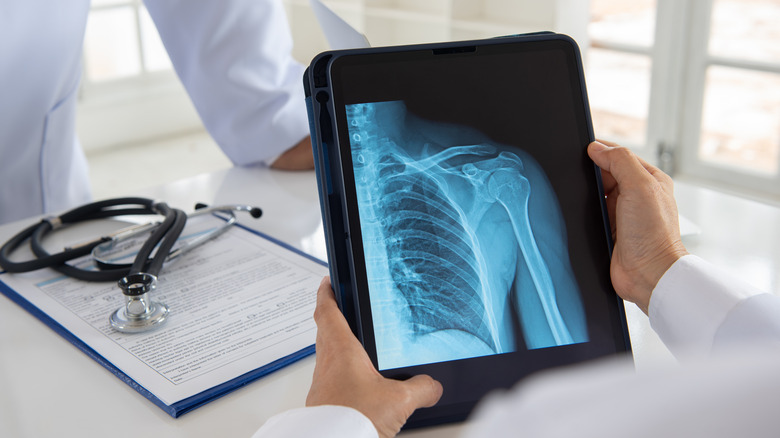 Bone X-ray from person with osteoporosis