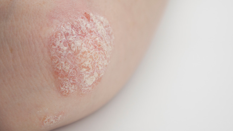 Skin rash with scales