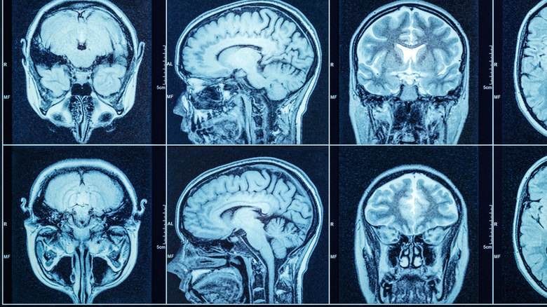 CT scan of brain