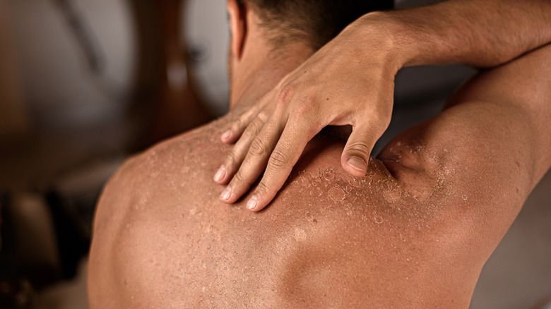 man's sunburn peeling on back