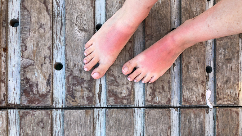 woman's red sunburned feet