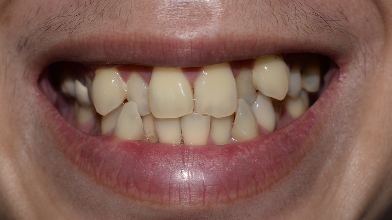 close-up of smile with crooked teeth