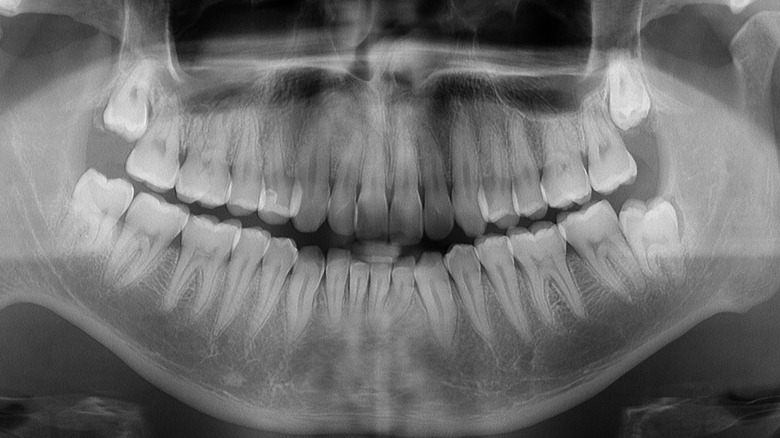 x-ray showing wisdom teeth