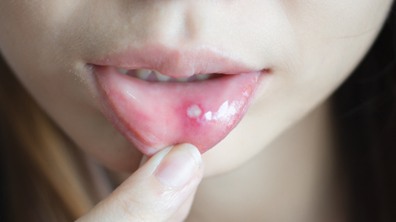 canker sore on inner lip