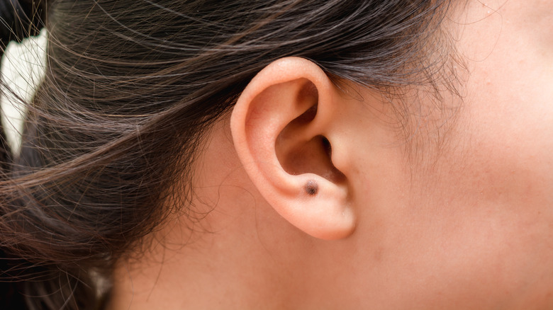 A woman with a congenital mole on her ear