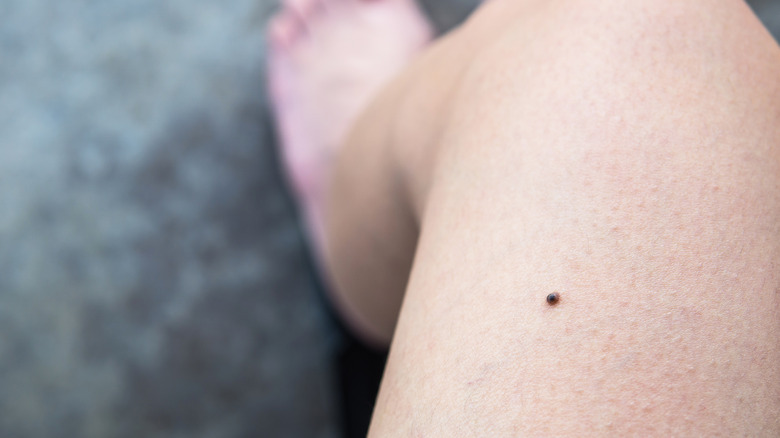 mole on person's thigh