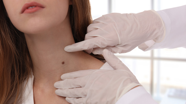 A mole on a woman's neck, being examined by a doctor