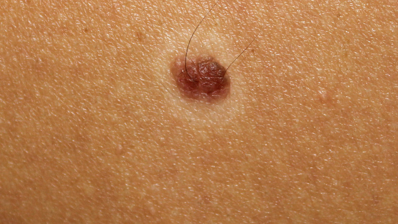 Closeup of a disappearing mole