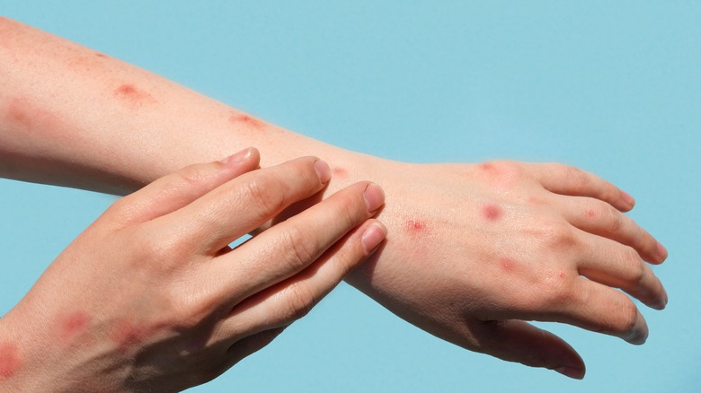 Hands and arms of Monkeypox patient