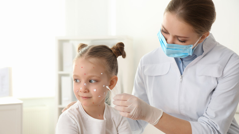Little girl being treated for the chickenpox