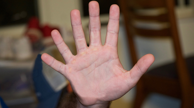 hand with six fingers