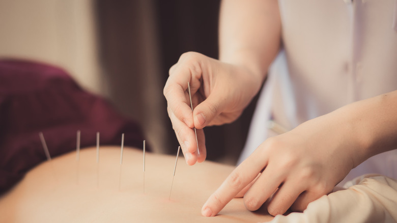 female receiving acupuncture treatment