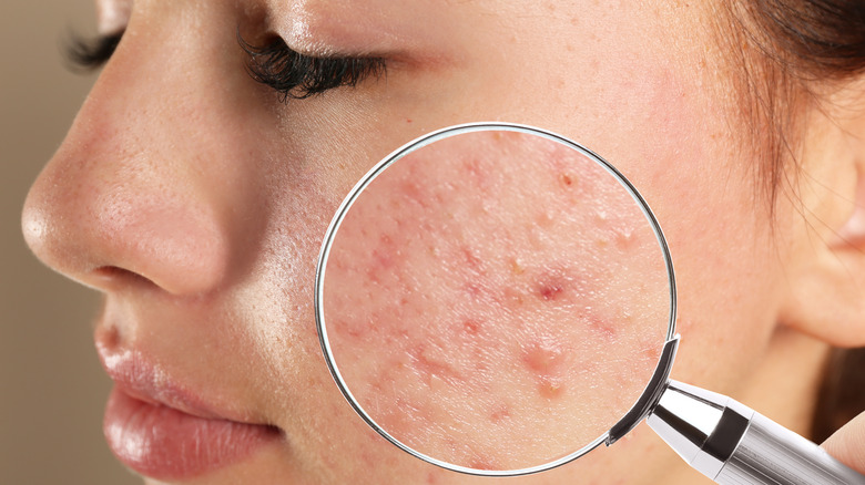 closeup of acne