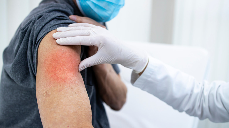 Person with redness at vaccination site