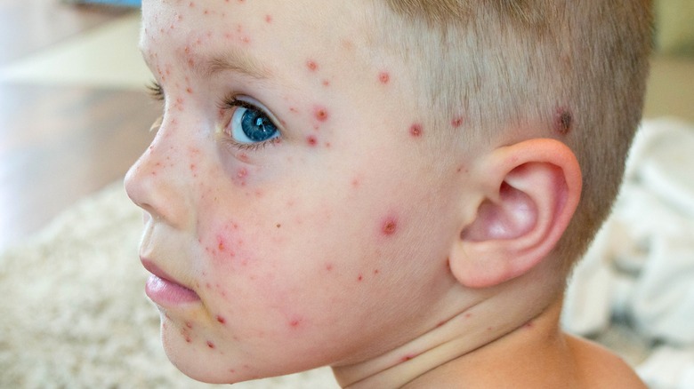 Kid with chickenpox