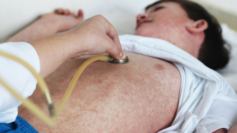 Child with measles examined by doctor