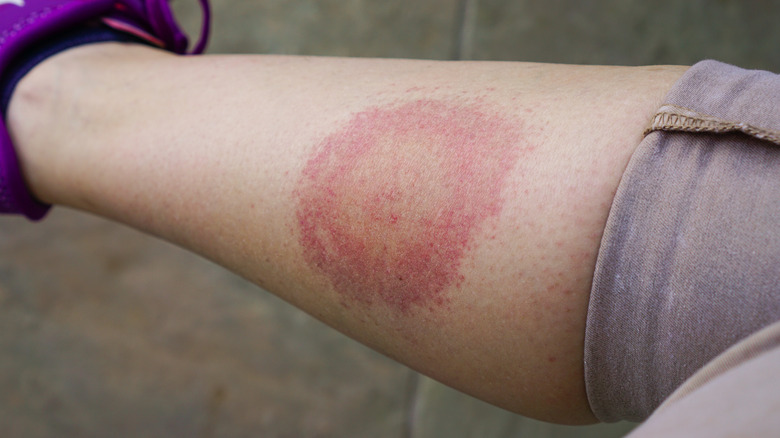 Classic bullseye rash from Lyme disease
