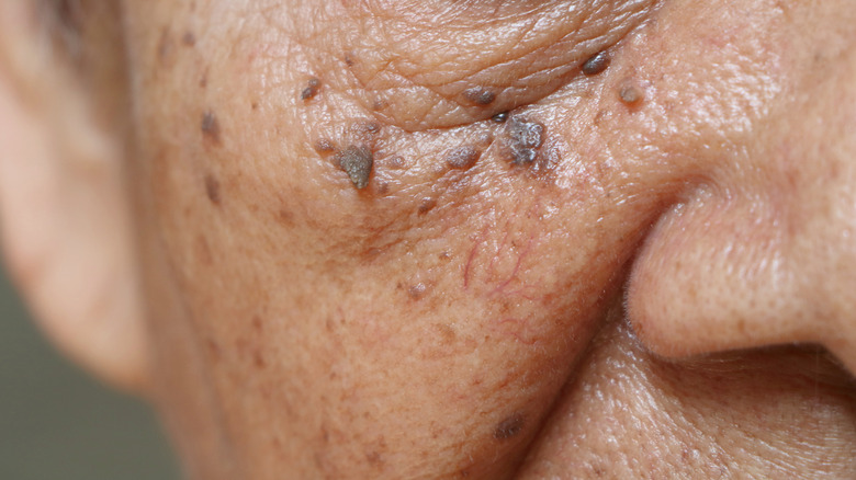 Closeup of skin tags on face