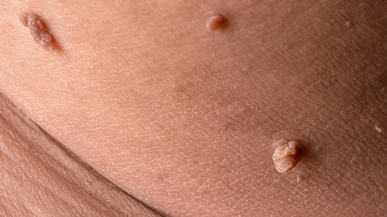 Closeup of multiple skin tags