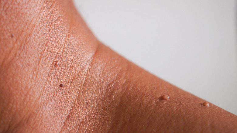 Closeup of skin tags