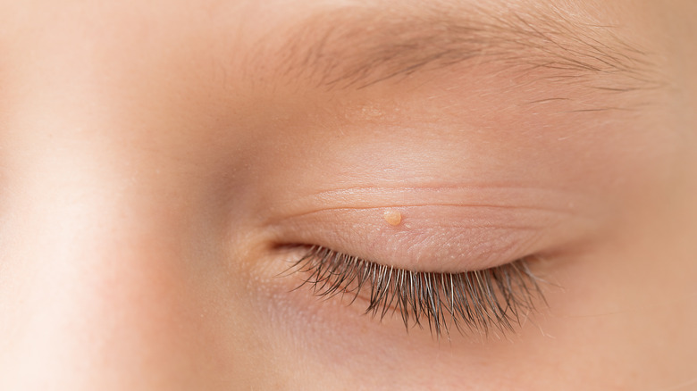 Skin tag on child's eyelid