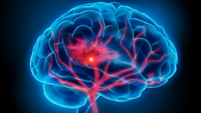 brain displaying stroke symptoms