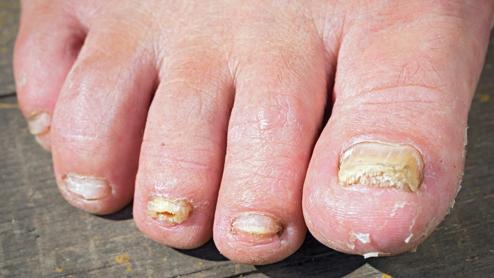 What Causes Toenail Fungus & How Can It Be Treated? | Arizona Foot Doctors