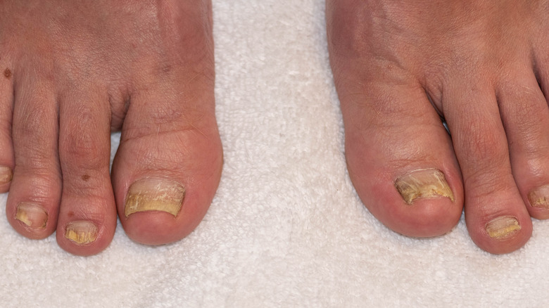 infected toenails replaced by new toenails