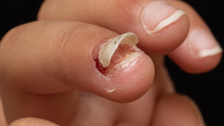 fingernail falling off nail bed due to Candida yeasts