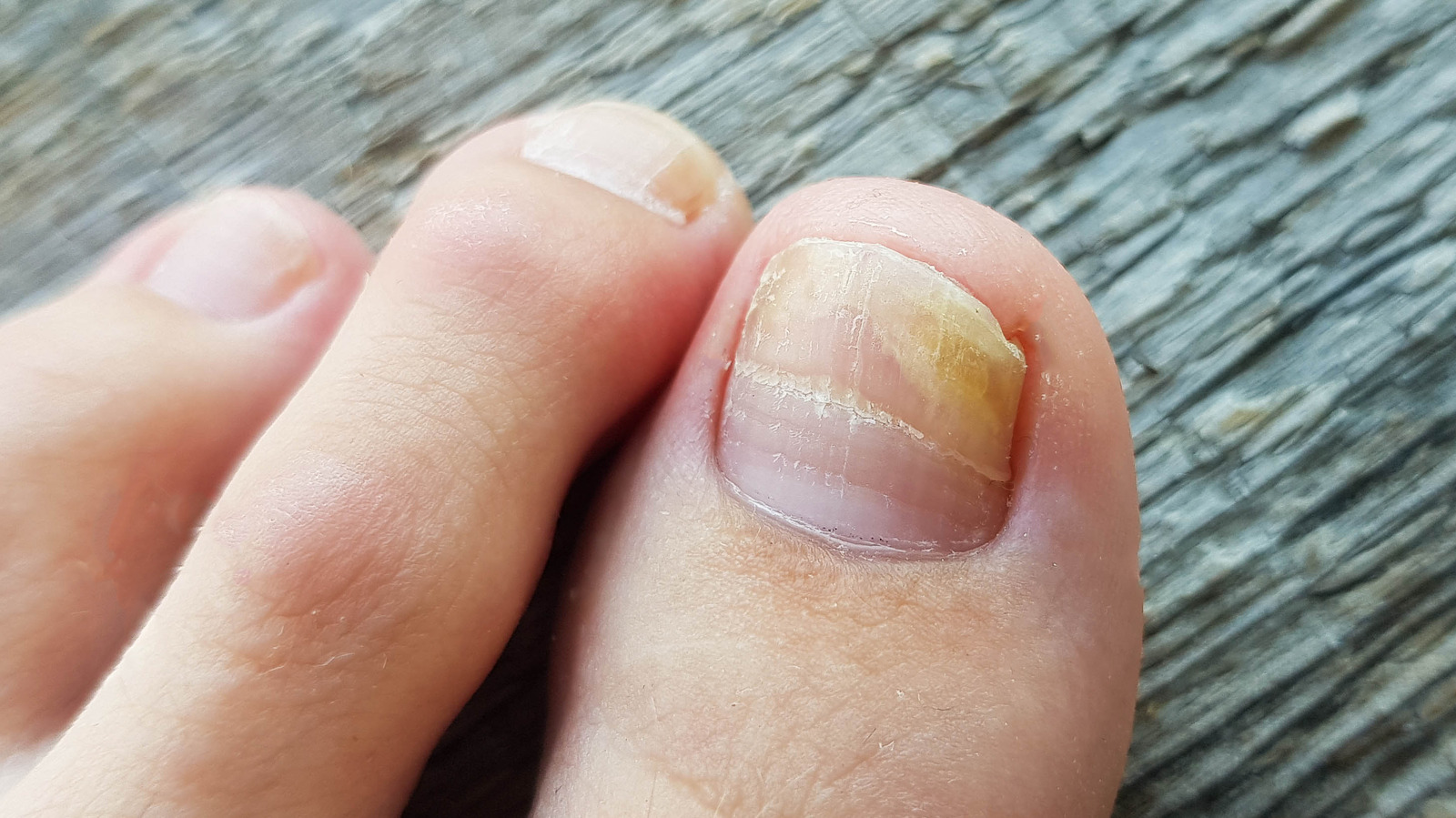 natural-ways-to-heal-toenail-fungus