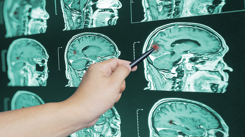 medical professional pointing to brain scans