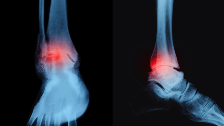xray illustrating pain with ankle osteoarthritis
