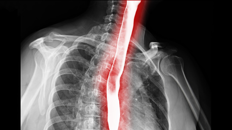 barium swallow test shows esophagus for diagnosis of GERD