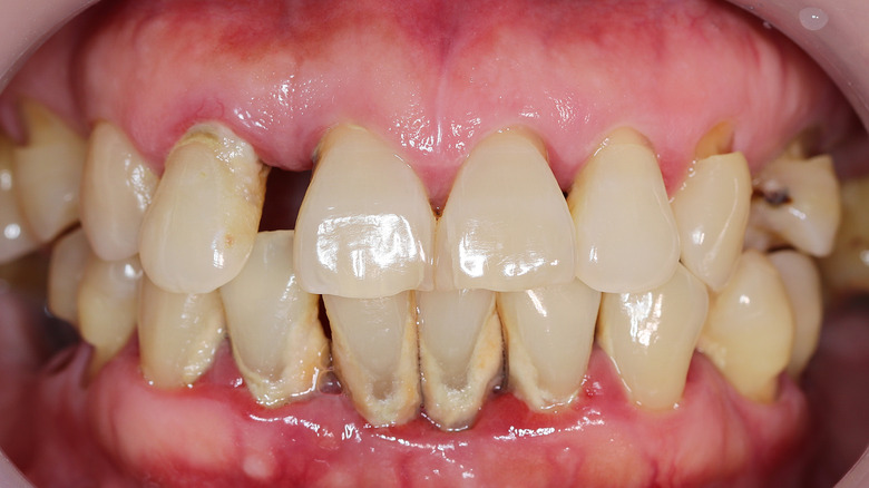 inflammation of gums and other structures