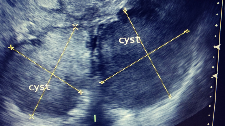 Ultrasound image of an ovary