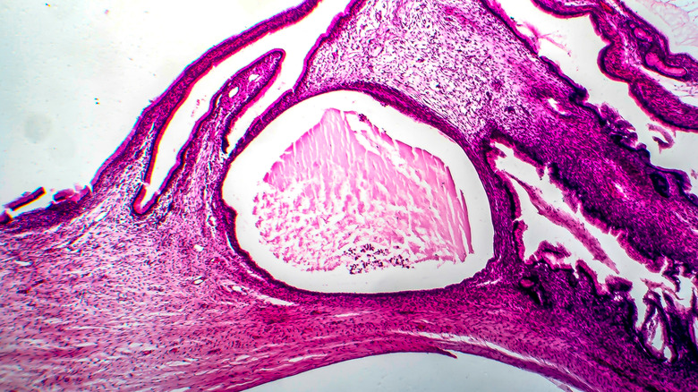 image of ovarian cystadenoma