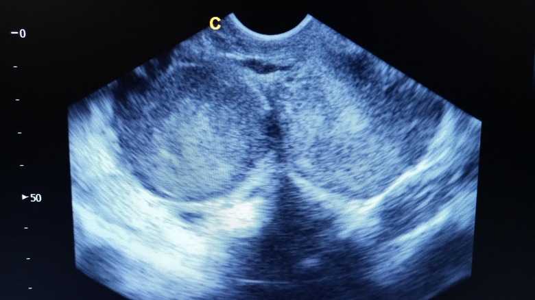Ultrasound image of endometrioma