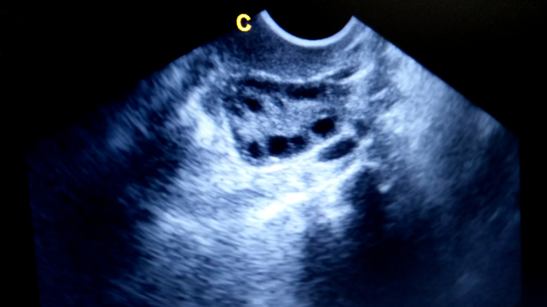 Ultrasound of an ovary
