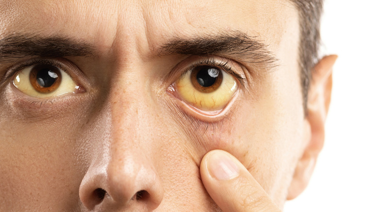 Jaundice in a man's eyes