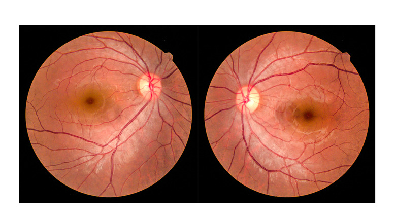 images of retina
