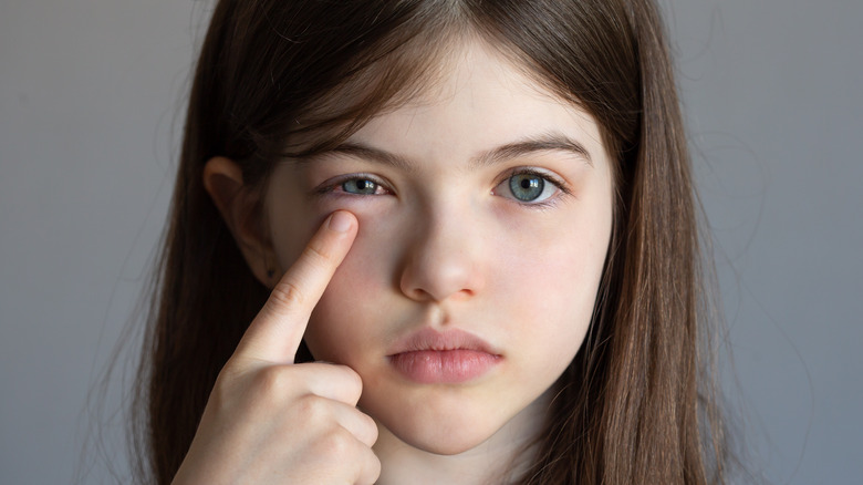 girl with a swollen eyelid