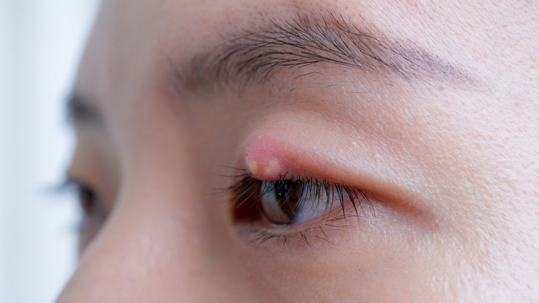 stye on upper eyelid