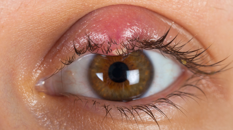 Pink Eye Vs Stye: What's The Difference?