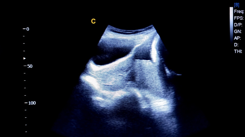 ultrasound image of placenta previa