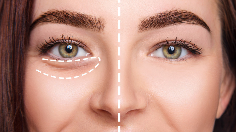 plastic surgery for under eye